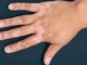 penyebab penyakit vitiligo menurut islam